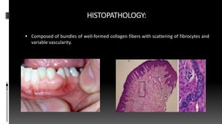 HISTOPATHOLOGY:
 Composed of bundles of well-formed collagen fibers with scattering of fibrocytes and
variable vascularity.
 