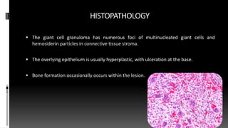 HISTOPATHOLOGY
 The giant cell granuloma has numerous foci of multinucleated giant cells and
hemosiderin particles in connective tissue stroma.
 The overlying epithelium is usually hyperplastic, with ulceration at the base.
 Bone formation occasionally occurs within the lesion.
 