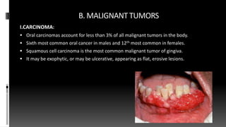 B. MALIGNANT TUMORS
I.CARCINOMA:
 Oral carcinomas account for less than 3% of all malignant tumors in the body.
 Sixth most common oral cancer in males and 12th most common in females.
 Squamous cell carcinoma is the most common malignant tumor of gingiva.
 It may be exophytic, or may be ulcerative, appearing as flat, erosive lesions.
 