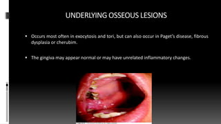 UNDERLYING OSSEOUS LESIONS
 Occurs most often in exocytosis and tori, but can also occur in Paget’s disease, fibrous
dysplasia or cherubim.
 The gingiva may appear normal or may have unrelated inflammatory changes.
 