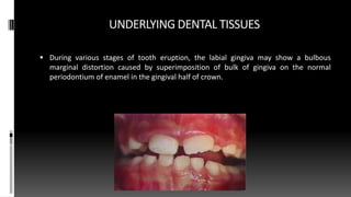 UNDERLYING DENTAL TISSUES
 During various stages of tooth eruption, the labial gingiva may show a bulbous
marginal distortion caused by superimposition of bulk of gingiva on the normal
periodontium of enamel in the gingival half of crown.
 