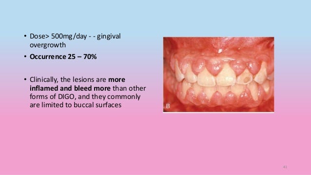 Gingival Enlargement Part 1 And Part 2