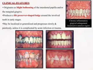 CLINICAL FEATURES
• Originates as Slight ballooning of the interdental papilla and/or
the marginal gingiva.
•Produces a life preserver-shaped bulge around the involved
teeth in early stages.
•May be localized or generalized and progresses slowly &
painlessly, unless it is complicated by acute infection or trauma.
Chronic inflammatory
gingival enlargement
localized to anterior region
 