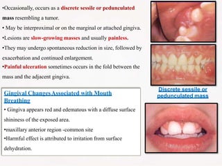Discrete sessile or
pedunculated mass
•Occasionally, occurs as a discrete sessile or pedunculated
mass resembling a tumor.
• May be interproximal or on the marginal or attached gingiva.
•Lesions are slow-growing masses and usually painless.
•They may undergo spontaneous reduction in size, followed by
exacerbation and continued enlargement.
•Painful ulceration sometimes occurs in the fold between the
mass and the adjacent gingiva.
Gingival ChangesAssociated with Mouth
Breathing
• Gingiva appears red and edematous with a diffuse surface
shininess of the exposed area.
•maxillary anterior region -common site
•Harmful effect is attributed to irritation from surface
dehydration.
 