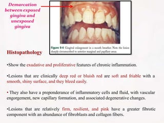 Histopathology
•Show the exudative and proliferative features of chronic inflammation.
•Lesions that are clinically deep red or bluish red are soft and friable with a
smooth, shiny surface, and they bleed easily.
• They also have a preponderance of inflammatory cells and fluid, with vascular
engorgement, new capillary formation, and associated degenerative changes.
•Lesions that are relatively firm, resilient, and pink have a greater fibrotic
component with an abundance of fibroblasts and collagen fibers.
Demarcation
between exposed
gingiva and
unexposed
gingiva
 