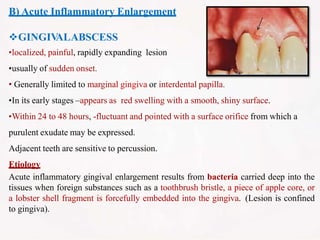 B) Acute Inflammatory Enlargement
GINGIV
ALABSCESS
•localized, painful, rapidly expanding lesion
•usually of sudden onset.
• Generally limited to marginal gingiva or interdental papilla.
•In its early stages –appears as red swelling with a smooth, shiny surface.
•Within 24 to 48 hours, -fluctuant and pointed with a surface orifice from which a
purulent exudate may be expressed.
Adjacent teeth are sensitive to percussion.
Etiology
Acute inflammatory gingival enlargement results from bacteria carried deep into the
tissues when foreign substances such as a toothbrush bristle, a piece of apple core, or
a lobster shell fragment is forcefully embedded into the gingiva. (Lesion is confined
to gingiva).
 