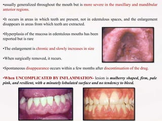 •usually generalized throughout the mouth but is more severe in the maxillary and mandibular
anterior regions.
•It occurs in areas in which teeth are present, not in edentulous spaces, and the enlargement
disappears in areas from which teeth are extracted.
•Hyperplasia of the mucosa in edentulous mouths has been
reported but is rare
•The enlargement is chronic and slowly increases in size
•When surgically removed, it recurs.
•Spontaneous disappearance occurs within a few months after discontinuation of the drug.
•When UNCOMPLICATED BY INFLAMMATION- lesion is mulberry shaped, firm, pale
pink, and resilient, with a minutely lobulated surface and no tendency to bleed.
 