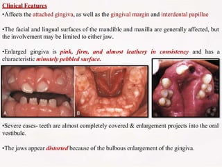 Clinical Features
•Affects the attached gingiva, as well as the gingival margin and interdental papillae
•The facial and lingual surfaces of the mandible and maxilla are generally affected, but
the involvement may be limited to either jaw.
•Enlarged gingiva is pink, firm, and almost leathery in consistency and has a
characteristic minutely pebbled surface.
•Severe cases- teeth are almost completely covered & enlargement projects into the oral
vestibule.
•The jaws appear distorted because of the bulbous enlargement of the gingiva.
 