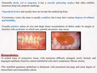 •Generally dusky red or magenta, it has a smooth, glistening surface that often exhibits
numerous deep-red, pinpoint markings.
•Superficial lesion and usually does not invade the underlying bone.
•Consistency varies; the mass is usually semifirm, but it may have various degrees of softness
and friability.
•Usually painless unless its size and shape foster accumulation of debris under its margin or
interfere with occlusion, in which case, painful ulceration may occur.
Histopathology
•A central mass of connective tissue, with numerous diffusely arranged, newly formed, and
engorged capillaries lined by cuboid endothelial cells and a moderately fibrous stroma.
•The stratified squamous epithelium is thickened, with prominent rete pegs and some degree of
intracellular and extracellular edema
 