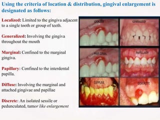 Localized: Limited to the gingiva adjacent
to a single tooth or group of teeth.
Generalized: Involving the gingiva
throughout the mouth
Marginal: Confined to the marginal
gingiva.
Papillary: Confined to the interdental
papilla.
Diffuse: Involving the marginal and
attached gingivae and papillae
Discrete: An isolated sessile or
pedunculated, tumor like enlargement
Using the criteria of location & distribution, gingival enlargement is
designated as follows:
 