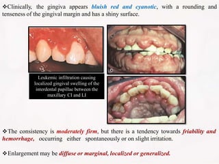 Clinically, the gingiva appears bluish red and cyanotic, with a rounding and
tenseness of the gingival margin and has a shiny surface.
Leukemic infiltration causing
localized gingival swelling of the
interdental papillae between the
maxillary CI and LI
The consistency is moderately firm, but there is a tendency towards friability and
hemorrhage, occurring either spontaneously or on slight irritation.
Enlargement may be diffuse or marginal, localized or generalized.
 