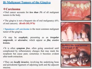 B) Malignant Tumors of the Gingiva
Carcinoma
Oral cancer accounts for less than 3% of all malignant
tumors in the body.
The gingiva is not a frequent site of oral malignancy (6%
of oral cancers). (Krolls SO,1976)
Squamous cell carcinoma is the most common malignant
tumor of the gingiva.
It may be exophytic, presenting as an irregular
outgrowth, or ulcerative, which appear as flat, erosive
lesions.
It is often symptom free, often going unnoticed until
complicated by inflammatory changes that may mask the
neoplasm but cause pain; sometimes it becomes evident
after tooth extraction.
They are locally invasive, involving the underlying bone
and periodontal ligament of adjoining teeth and the adjacent
mucosa.
mulberry-like tissue between
2nd PM and 1st M
 