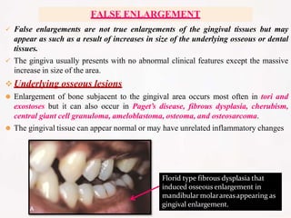  False enlargements are not true enlargements of the gingival tissues but may
appear as such as a result of increases in size of the underlying osseous or dental
tissues.
 The gingiva usually presents with no abnormal clinical features except the massive
increase in size of the area.
 Underlying osseous lesions
⚫ Enlargement of bone subjacent to the gingival area occurs most often in tori and
exostoses but it can also occur in Paget’s disease, fibrous dysplasia, cherubism,
central giant cell granuloma, ameloblastoma, osteoma, and osteosarcoma.
⚫ The gingival tissue can appear normal or may have unrelated inflammatory changes
FALSE ENLARGEMENT
Florid type fibrous dysplasia that
induced osseous enlargement in
mandibular molarareasappearing as
gingival enlargement.
 