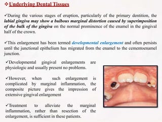 Underlying Dental Tissues
During the various stages of eruption, particularly of the primary dentition, the
labial gingiva may show a bulbous marginal distortion caused by superimposition
of the bulk of the gingiva on the normal prominence of the enamel in the gingival
half of the crown.
This enlargement has been termed developmental enlargement and often persists
until the junctional epithelium has migrated from the enamel to the cementoenamel
junction.
Developmental gingival enlargements are
physiologic and usually present no problems.
by marginal inflammation,
However,
complicated
composite picture gives the impression
when such enlargement is
the
of
extensive gingival enlargement
marginal
Treatment to alleviate
inflammation, rather than
the
resection of the
enlargement, is sufficient in these patients.
 