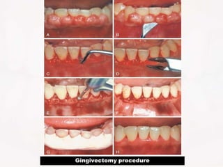 Gingivectomy procedure
 