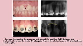17
 Factors determining the presence and form of the papillae: A, B) Distance and
inclination between the teeth; (D) triangular form of the clinical crown, (C) alveolar bone
crest height.
 