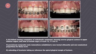 34
A, B) Patient nearing completion of orthodontic treatment, showing uneven gingival contour in upper
anterior region, and wear of incisal edges of teeth 12, 11 and 21
C) provisional composite resin restorations established a new incisal silhouette and new anatomical
proportions for these teeth
D) rebonding of brackets taking as reference the apical gingival margin of incisors
1
 