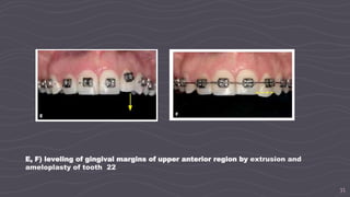 35
E, F) leveling of gingival margins of upper anterior region by extrusion and
ameloplasty of tooth 22
 