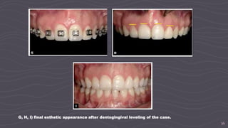36
G, H, I) final esthetic appearance after dentogingival leveling of the case.
 