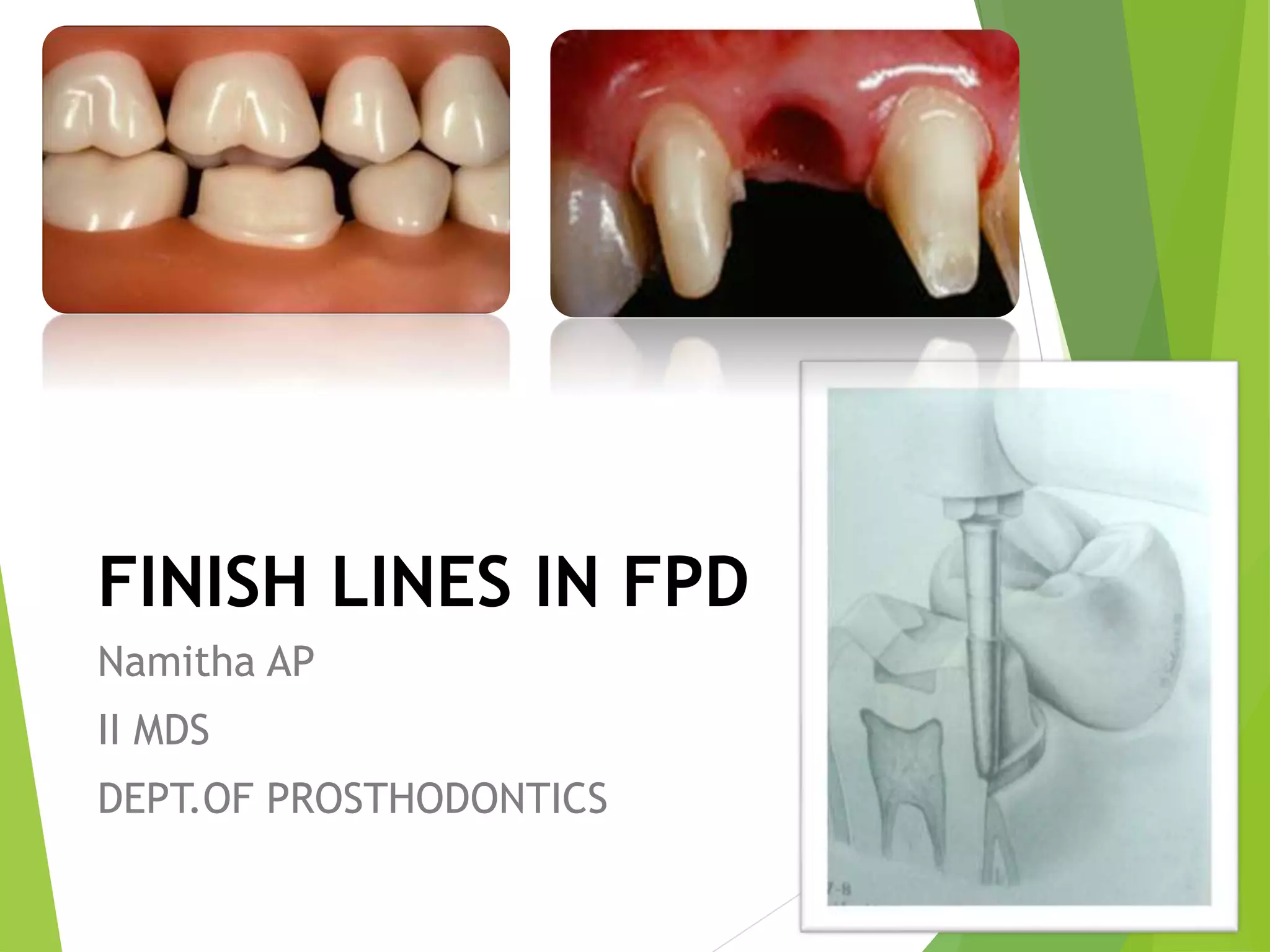 Gingival finish lines in fixed prosthodontics PPT