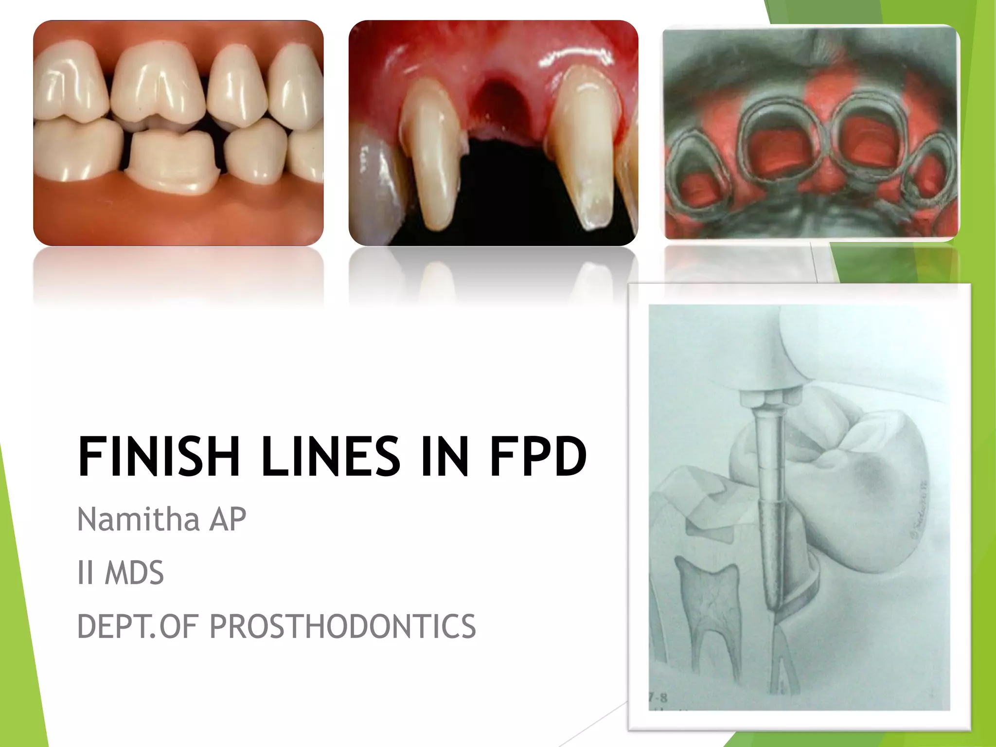 Gingival finish lines in fixed partial denture(FPD) with references PPT