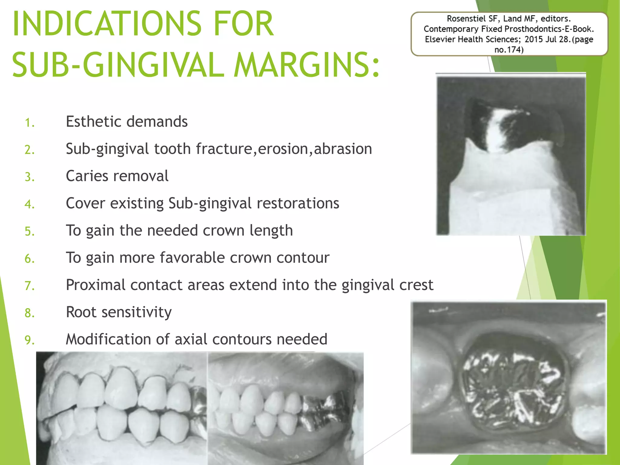 Gingival finish lines in fixed partial denture(FPD) with references PPT