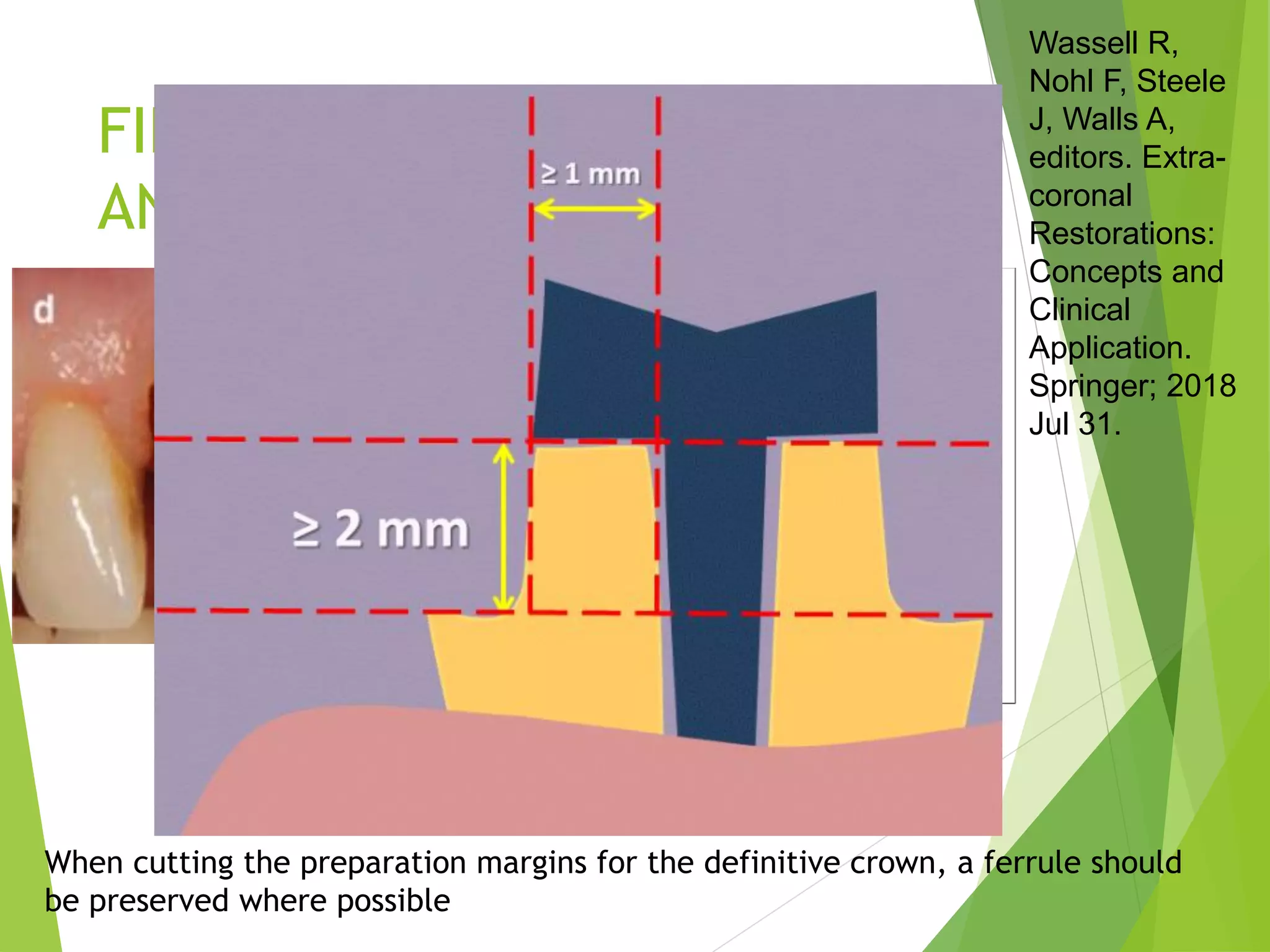 Gingival finish lines in fixed partial denture(FPD) with references PPT