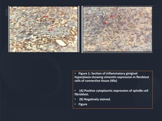 • Figure 1: Section of inflammatory ginigival
hyperplasia showing vimentin expression in fbroblast
cells of connective tissue (40x)
• (A) Positive cytoplasmic expression of spindle cell
fibroblast.
• (B) Negatively stained.
• Figure
 