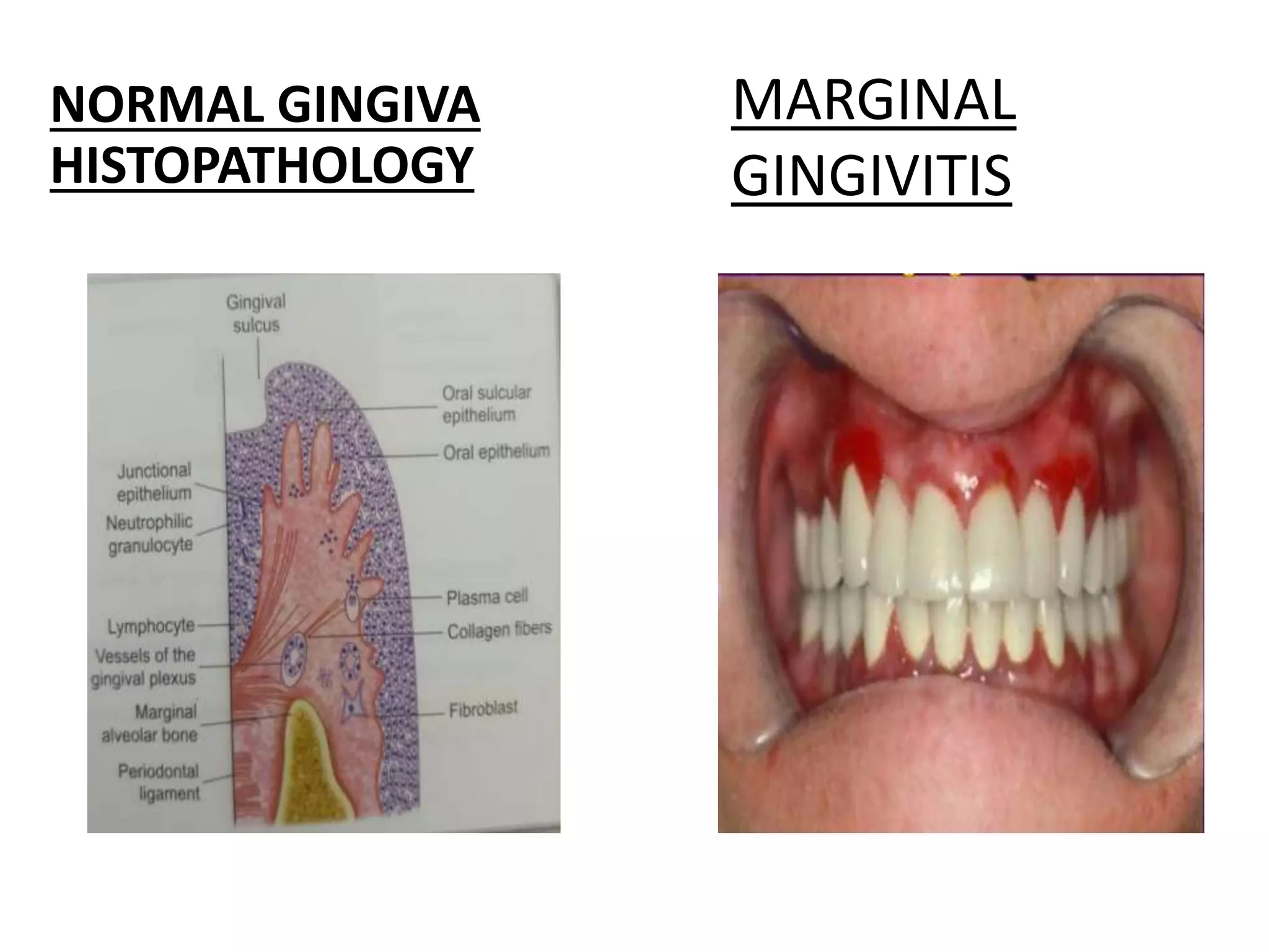 GINGIVAL INFLAMMATION | PPTX