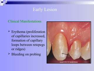 Early Lesion
Clinical Manifestations
 Erythema (proliferation
of capillaries increased,
formation of capillary
loops between retepegs
or ridges)
 Bleeding on probing
 