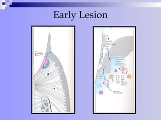 Early Lesion
 