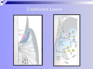 Established Lesion
 