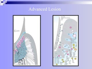 Advanced Lesion
 