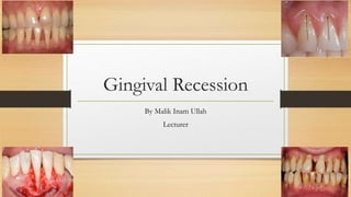 Gingival Recession
By Malik Inam Ullah
Lecturer
 