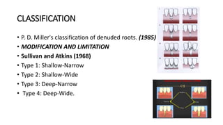 New Miller Classification Gingival recession | PPTX