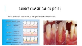 Gingival Recession.pptxhsudueheueduehhehehe | PPTX
