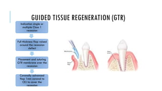 Single Recession Defect Gingival Recession.pptxhsudueheueduehhehehe | PPTX