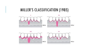 Gingival Recession.pptxhsudueheueduehhehehe | PPTX