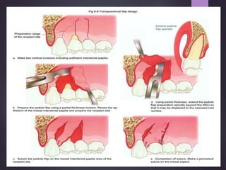 Gingival recession aries | PPTX