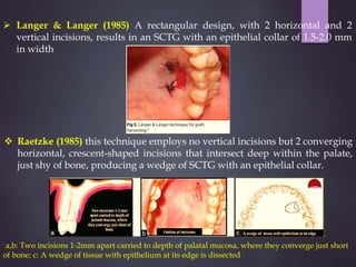 Gingival recession aries | PPTX
