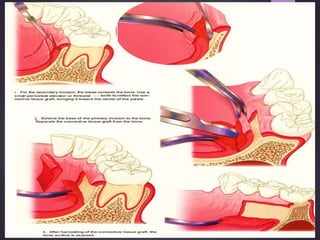 Gingival recession aries | PPTX