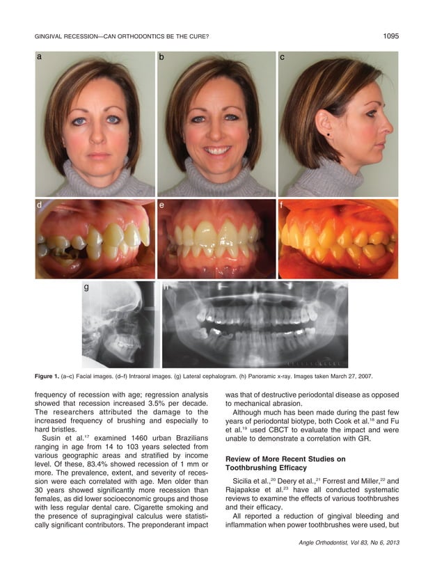 Gingival recession—can orthodontics be a cure? evidence from a case presentation