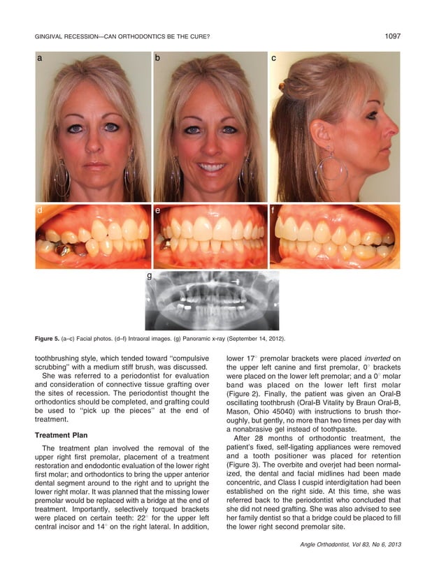 Gingival recession—can orthodontics be a cure? evidence from a case presentation