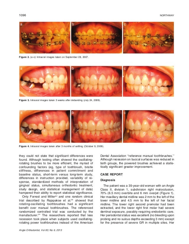 Gingival recession—can orthodontics be a cure? evidence from a case p…