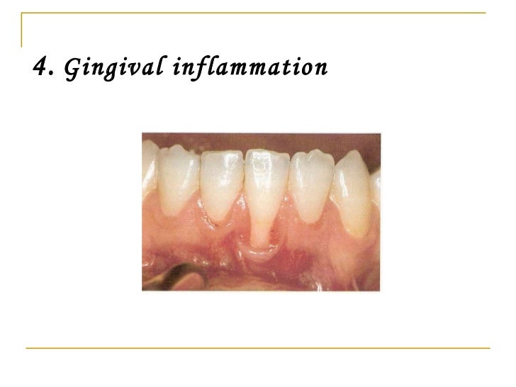 gingival recession