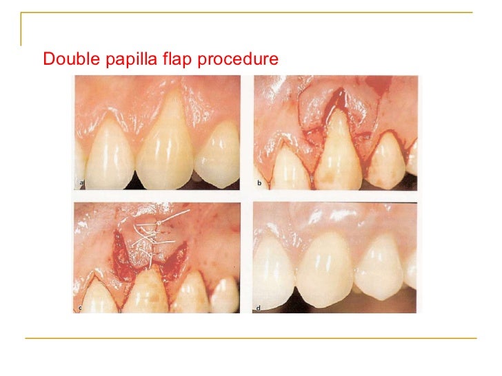 gingival recession