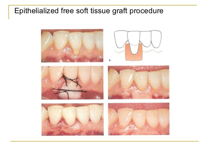 gingival recession