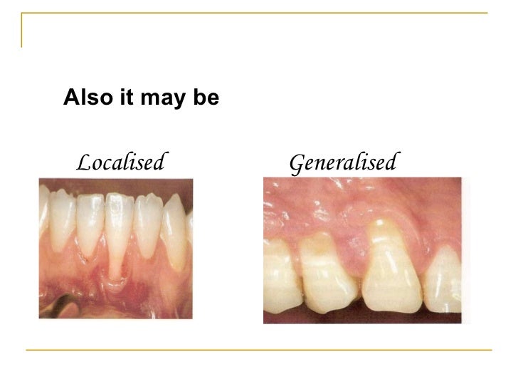 gingival recession