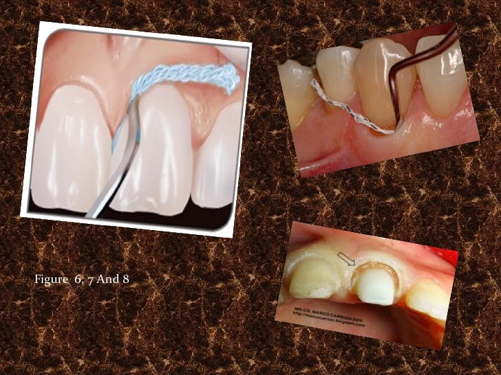 Gingival retraction