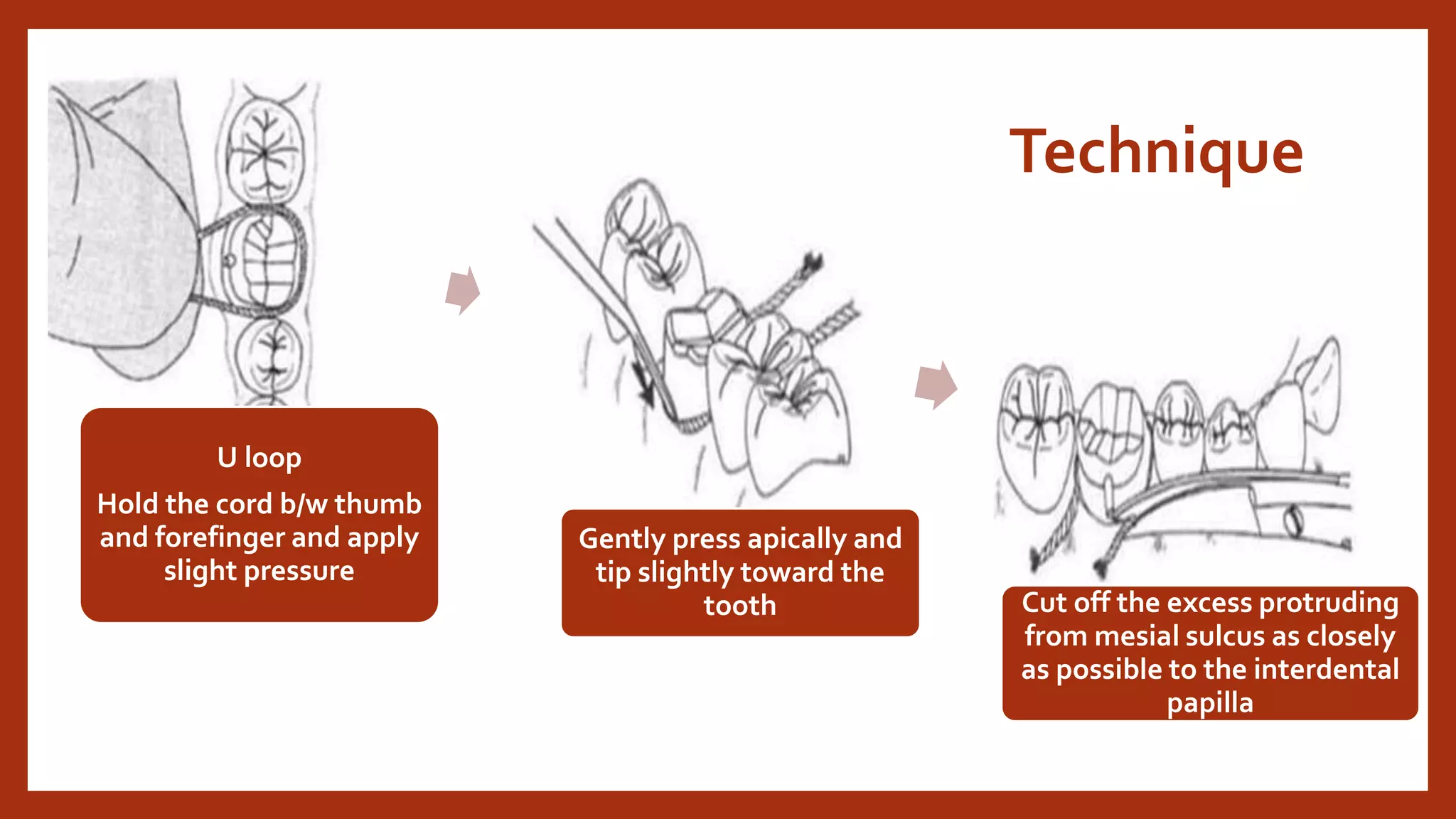 Gingival retraction.pptx